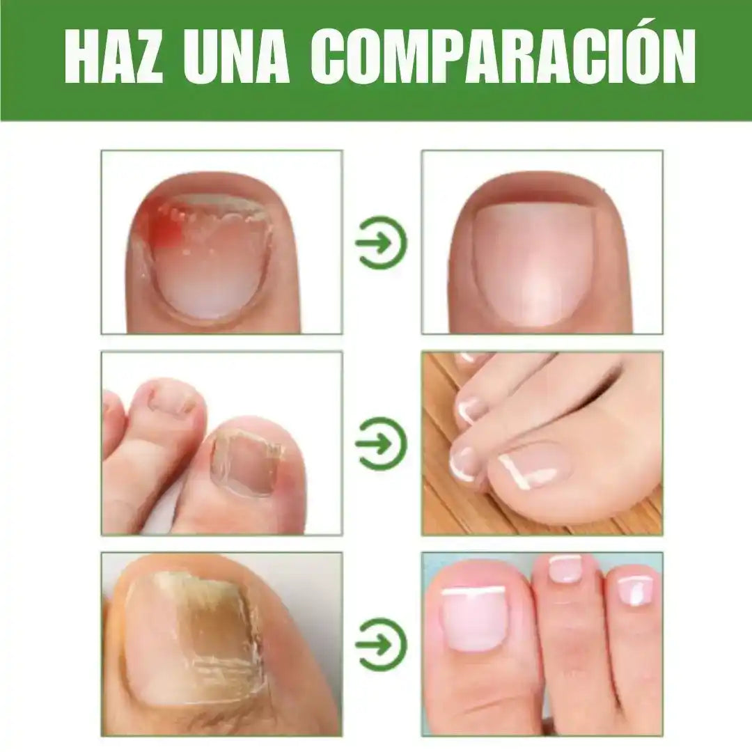 UÑA VITAL: el secreto para uñas fuertes, perfectas y sin hongos💅✨